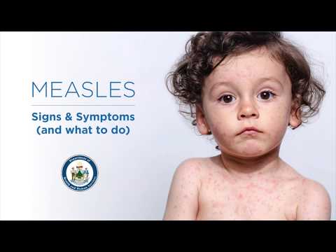 How do you treat measles in babies fast?