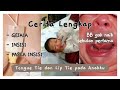 Tongue Tie dan Lip Tie: Gejala, Penanganan (Insisi), Perawatan Pasca Insisi (CERITA LENGKAP)