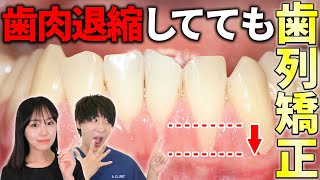 歯肉退縮していても歯列矯正する方法！【歯茎下がり】