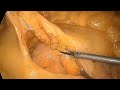 The application of sandwich theory in right hemicolectomy– a video vignette