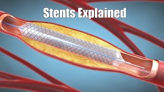 What is a stent? (3D animation)