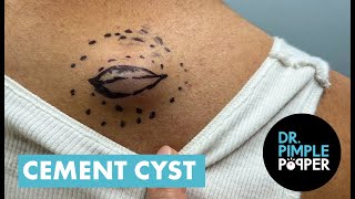 "It's Like a Cement Truck" - Dr Pimple Popper Removes The Cement Cyst