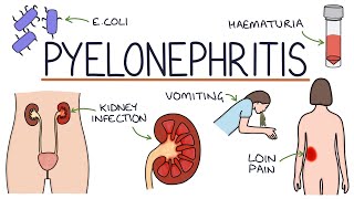 Understanding Pyelonephritis (Kidney Infections)