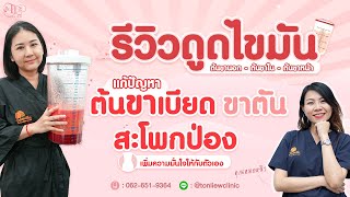 รีวิวดูดไขมันต้นขา ดูดไขมันสะโพก คลินิกที่เพื่อนๆแนะนำ - หมอหลิว ต้นหลิวคลินิก