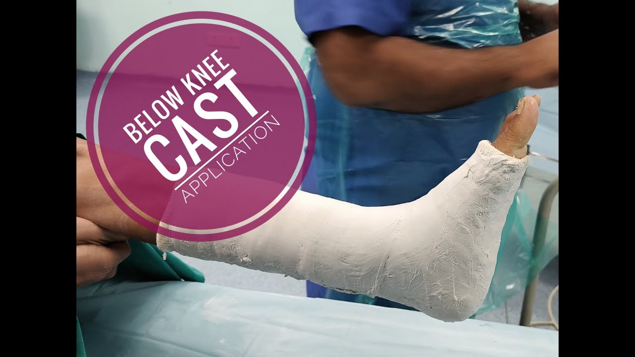 Below Knee Plaster Cast Application Youtube