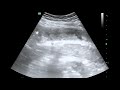 Small Bowel Ultrasound