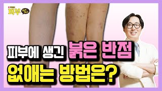 팔다리에 생기는 붉은 반점, 자반증의 종류와 생활 관리법 - 박치영의 피부 톡톡 #23 자반증 치료 방법