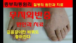 무지외반증 진실! 수술전에 꼭 보세요. 종부파동원리는 건강한 발을 가지게 합니다. jb circle therapy