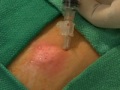 abscess incision and drainage