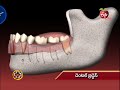 aarogyamastu dental bridge 1st september 2016 ఆరోగ్యమస్తు