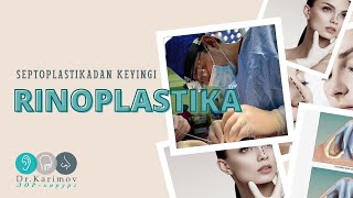 Avval #Septoplastika o’tkazgan bemorda bugun #RINOPLASTIKA amaliyoti bajarildi.