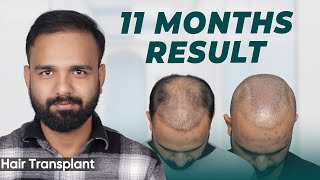 Hair Transplant in Jaipur | Best Results \u0026 Cost of Hair Transplant in Jaipur