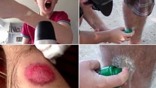 Crazy Aerosol Challenge Has Teens Burning Themselves with Sprays Just for Kicks