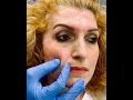 botox για τις Ρυτίδες Έκφρασης u0026 Υαλουρονικό για τις Ρινοπαρειακές