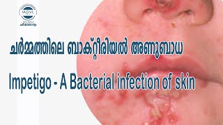 Impetigo-A Bacterial infection of skin ചർമ്മത്തിലെ ബാക്റ്റീരിയൽ അണുബാധ