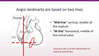 STS U 2020 Course 10: Transseptal Puncture for Surgeons