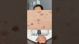 激光的副作用？ 做之前一定要看!(上） #醫美 #黃褐斑 #雷射祛斑 #雷射