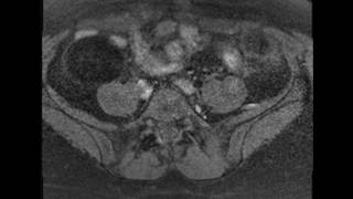 Ovarian Dermoid