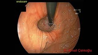 Sliding type hiatal hernia with Cameron ulcer and Schatzki ring - Endoscopy by Dr. İsmail Çalıkoğlu