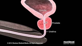 What is Benign Prostatic Hyperplasia (BPH)?