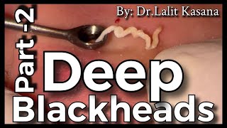 Deep Blackhead Removal by Dr.Lalit Kasana Part -2 / Goldmine of Blackheads