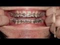 Braces - Photo taken every day - Before and After Transformation - Orthodontics Timelapse