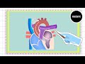 Babies with misshapen hearts: single-ventricle defects