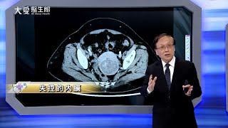 【大愛醫生館】失控的內膜 20240322