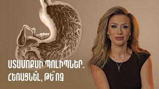 Ստամոքսի պոլիպներ․ հեռացնե՞լ, թե՞ ոչ | Gastro Time 72