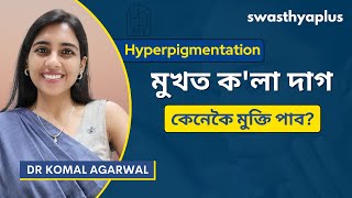 হাইপাৰপিগমেণ্টেচন: চিকিৎসা কি? | Hyperpigmentation/ Dark Patches, in Assamese | Dr Komal Agarwal