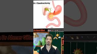 Bilroth 1 Gastrectomy Animation #health #mbbs #viral