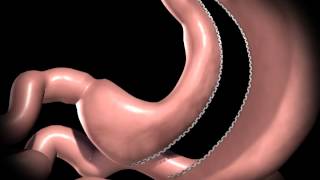 Realize Sleeve Gastrectomy Procedure Animation