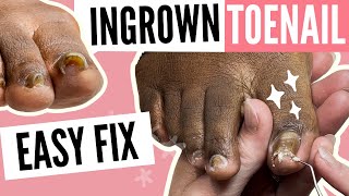 Step by Step Ingrown Toenail Pedicure Transformation