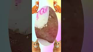 Blackheads Removal | Acne Treatment and Very Satisfying Satisfying Pimple pop #blackheads