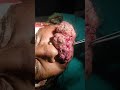 maggots in mouth oral cancer squamous cell carcinoma nishtar hospital multan