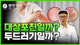 두드러기 vs 대상포진 차이 절대 헷갈리지 마세요!