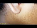 মাম্পস বা গাল ফোলা রাতারাতি দূর করার ঘরোয়া উপায় mumps treatment home remedy