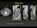 bowel u0026 mesentery injury high risk mechanisms and ct findings