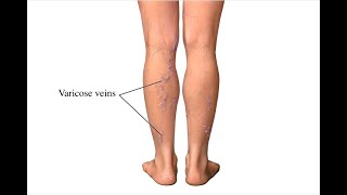 Varicose vein/நரம்பு சிலந்தி/Siddha medicine/Dr.R.Bharathi Suresh