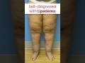 She self-diagnosed with Lipedema. Were you too? #lipedema #shorts_feed