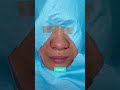 ALARPLASTY ON SMALL NOSE - DR. TANVEER JANJUA- NEW JERSEY