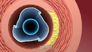 Vesselin Drug Coated Coronary Balloon Catheter