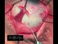 the ideal drainage of sub retinal fluid in scleral buckle surgery