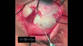 The ideal drainage of sub retinal fluid in scleral buckle surgery