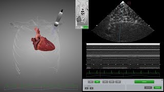 HeartWorks Pneumothorax