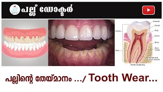 പല്ലിന്റെ തേയ്‌മാനം ...Tooth wear... attrition Abrasion abfraction  Erosion by Dr Nechupadam