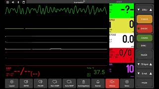 Ventricular fibrillation