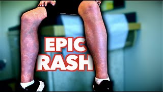 ERYTHEMA MULTIFORME... (Rare Rash) | Dr. Paul