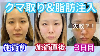 【閲覧注意❗️整形のリアル】カウンセリング〜3日目まで(クマ取り・脂肪注入・ボトックス)