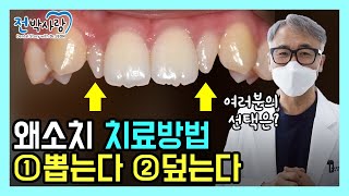 치아 깎지도 않았는데 이렇게 작아? 왜소치 치료방법은?!